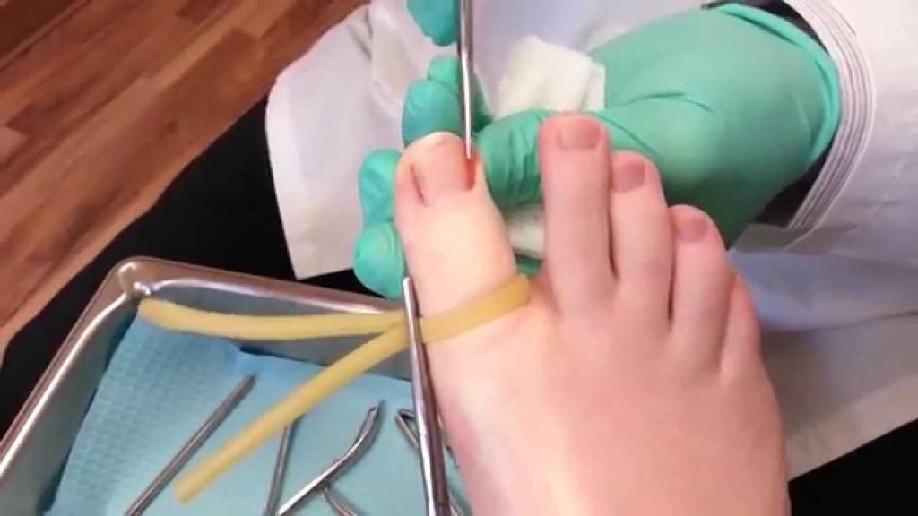 Ingrown toenail surgery